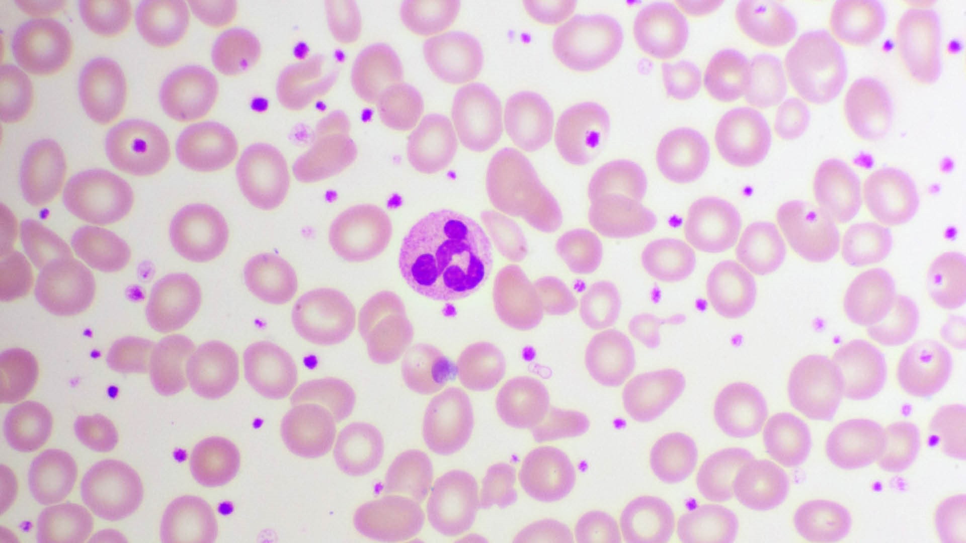 Blutausstrich mit erhöhter Anzahl an Thrombozyten und weißen Blutkörperchen, analysiert unter dem Mikroskop