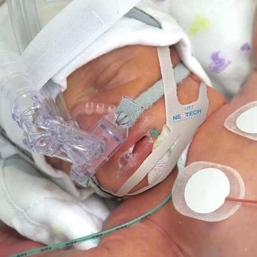 Baby wird nasal beatmet, der Mund wird mit ChinStrap geschlossen gehalten.