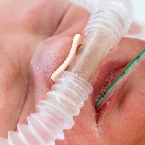 Babygesicht mit NeoSeal vor dem nasalen CPAP Beatmungsschlauch